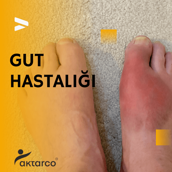 gut hastalığı, gut hastaligi, gut hastalığı nedir, gut hastalığı belirtileri, 