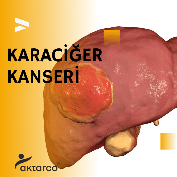 karaciğer kanseri belirtileri, karaciğer kanseri, karaciğerde kanser, karaciğer kanserinin belirtileri, 